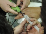 Odstranění prstenu z ruky muže v tanvaldské nemocnici